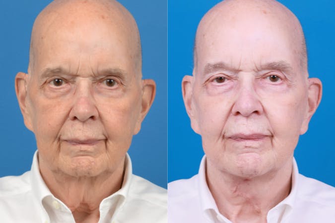 Male Neck Lift Before & After Gallery - Patient 122406328 - Image 1