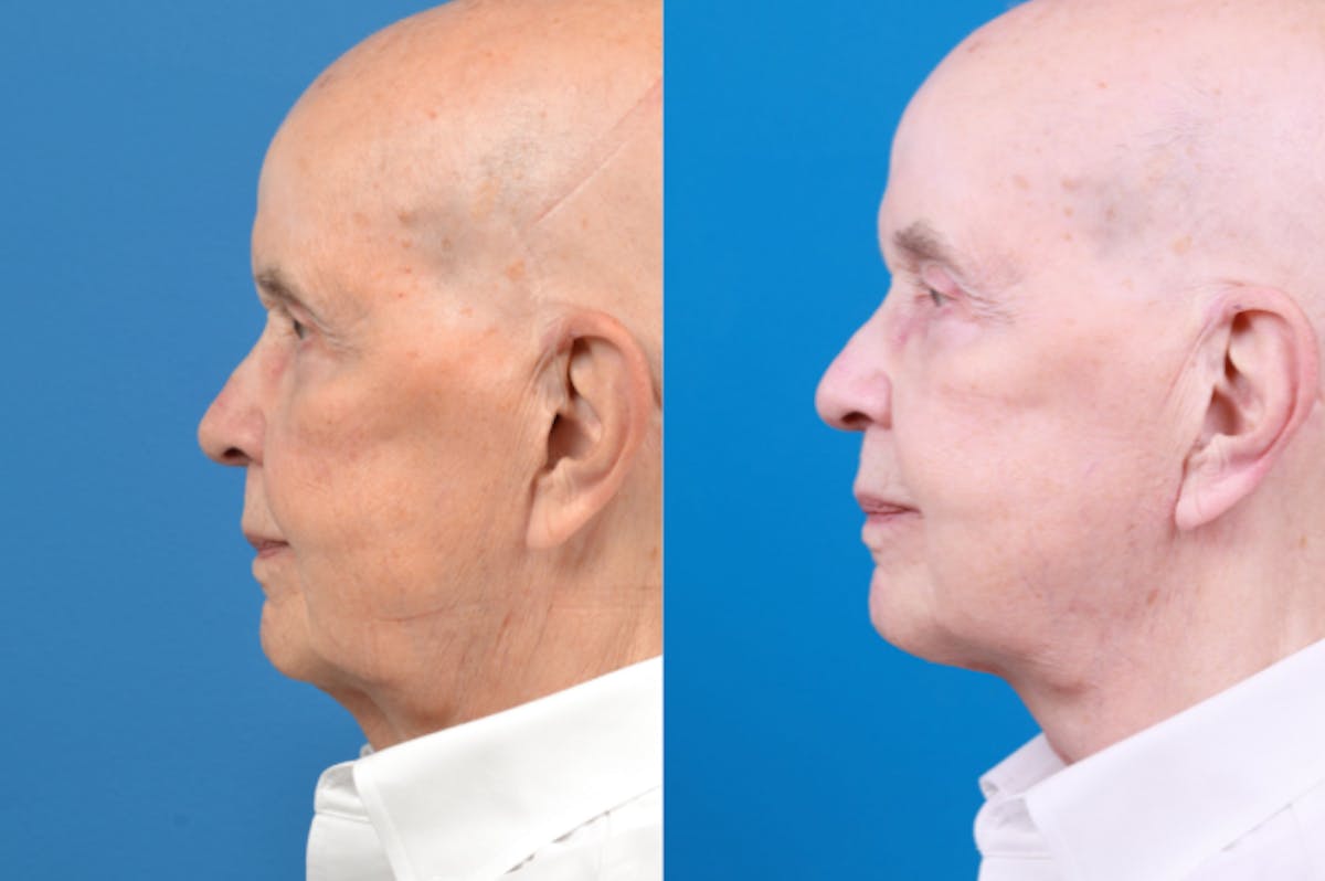 Male Neck Lift Before & After Gallery - Patient 122406328 - Image 2