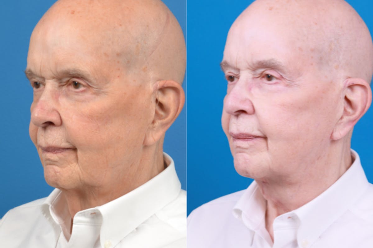 Male Neck Lift Before & After Gallery - Patient 122406328 - Image 3
