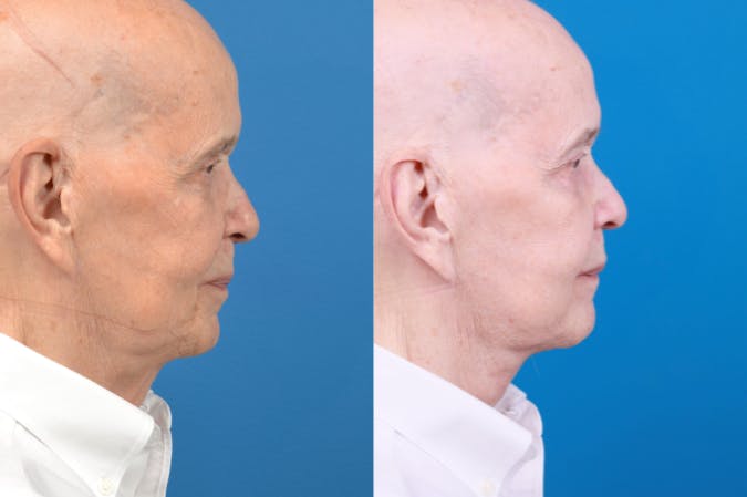 Male Neck Lift Before & After Gallery - Patient 122406328 - Image 4