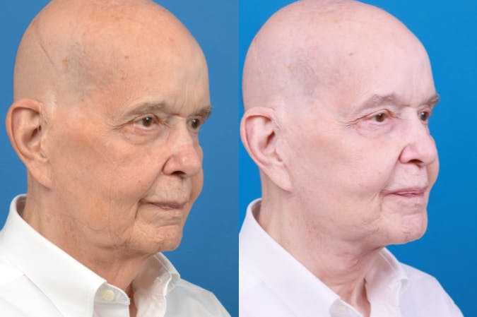 Male Neck Lift Before & After Gallery - Patient 122406328 - Image 5