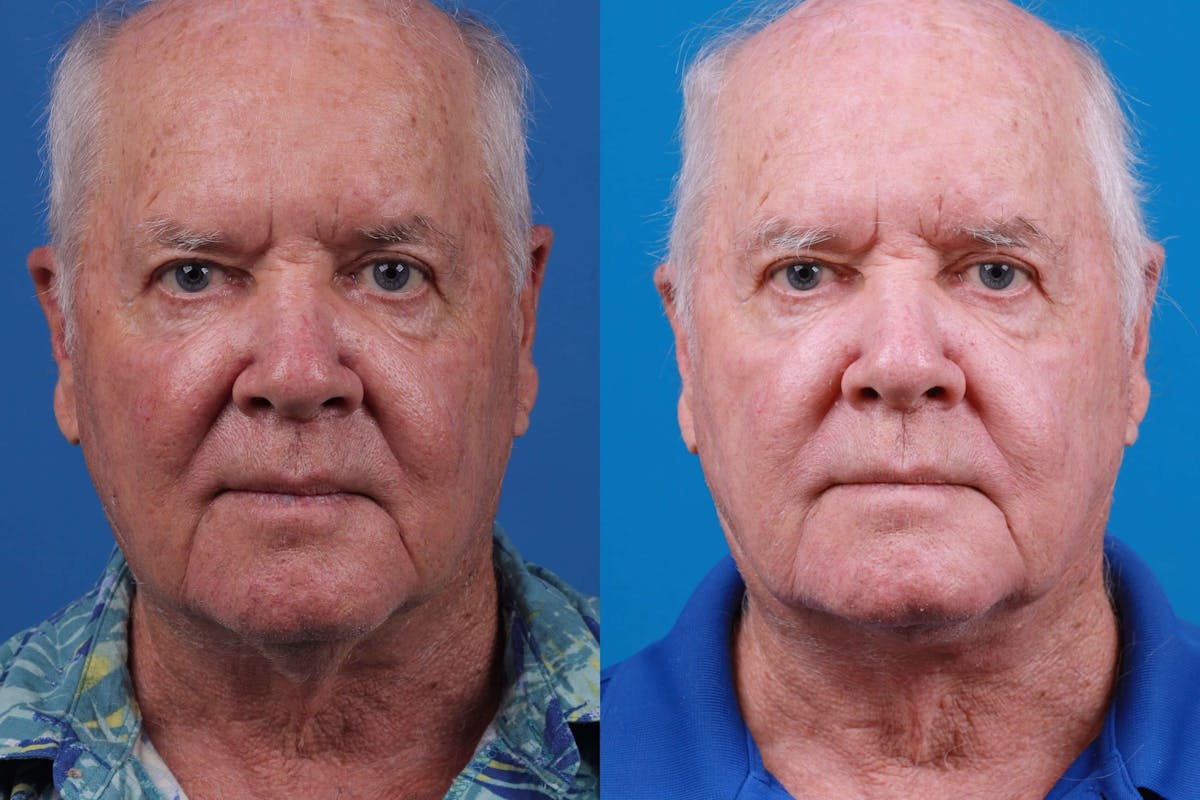 Male Neck Lift Before & After Gallery - Patient 122406333 - Image 1