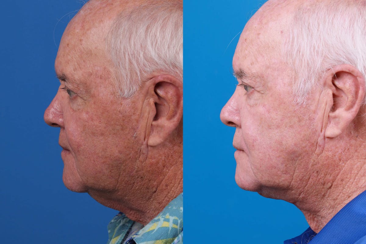 Male Neck Lift Before & After Gallery - Patient 122406333 - Image 2