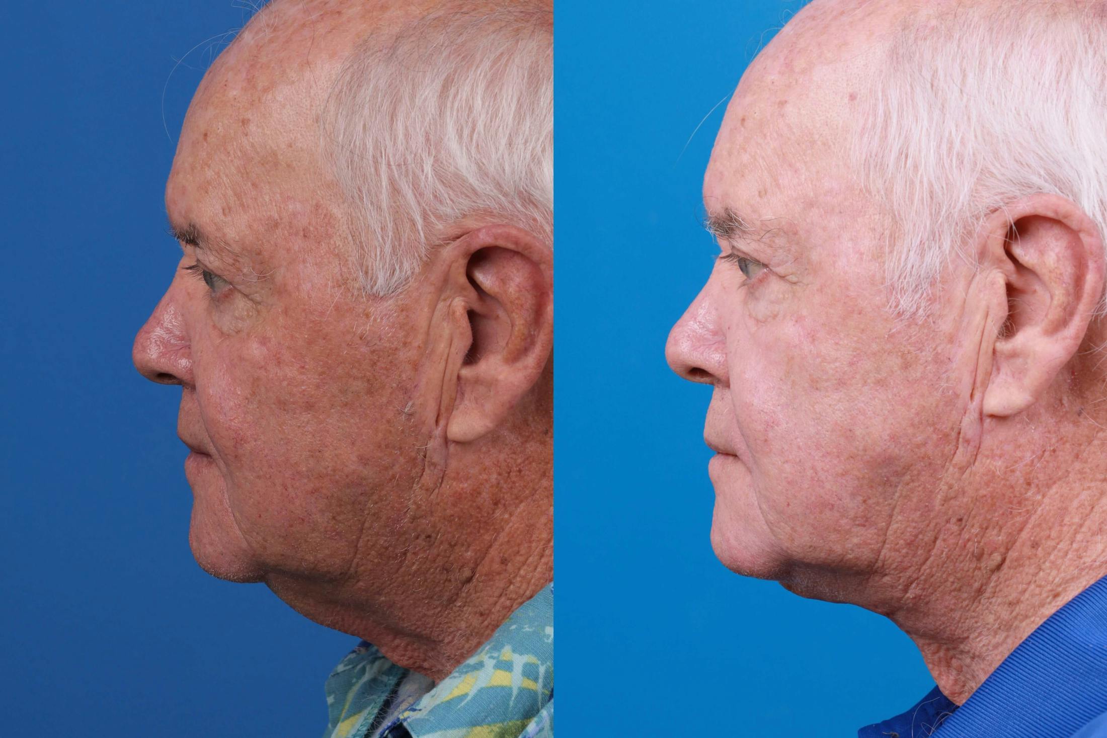 Male Neck Lift Before & After Gallery - Patient 122406333 - Image 2