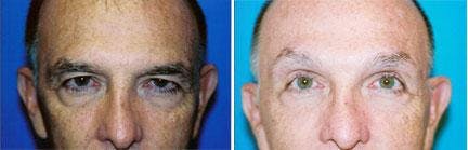 Male Eyelid Surgery Before & After Gallery - Patient 122406338 - Image 1