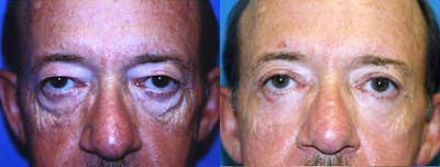 Male Eyelid Surgery Before & After Gallery - Patient 122406339 - Image 1