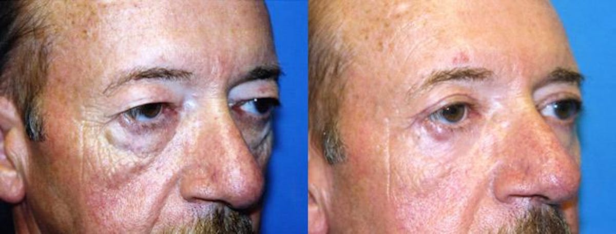 Male Eyelid Surgery Before & After Gallery - Patient 122406339 - Image 2