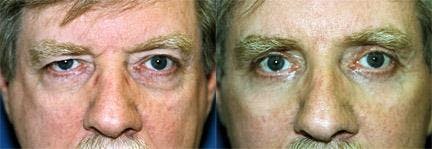 Male Eyelid Surgery Before & After Gallery - Patient 122406340 - Image 1