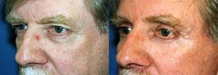 Male Eyelid Surgery Before & After Gallery - Patient 122406340 - Image 2