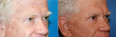 Male Eyelid Surgery Before & After Gallery - Patient 122406341 - Image 1