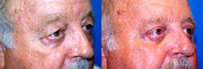 Male Eyelid Surgery Before & After Gallery - Patient 122406342 - Image 1