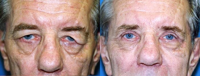 Male Eyelid Surgery Before & After Gallery - Patient 122406343 - Image 1