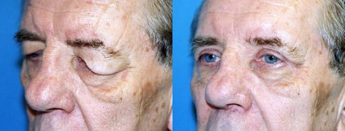 Male Eyelid Surgery Before & After Gallery - Patient 122406343 - Image 2