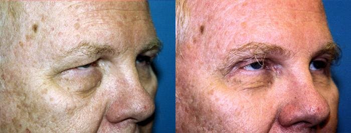 Male Eyelid Surgery Before & After Gallery - Patient 122406344 - Image 1