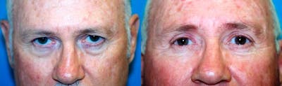 Male Eyelid Surgery Before & After Gallery - Patient 122406345 - Image 1
