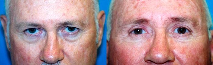 Male Eyelid Surgery Before & After Gallery - Patient 122406345 - Image 1