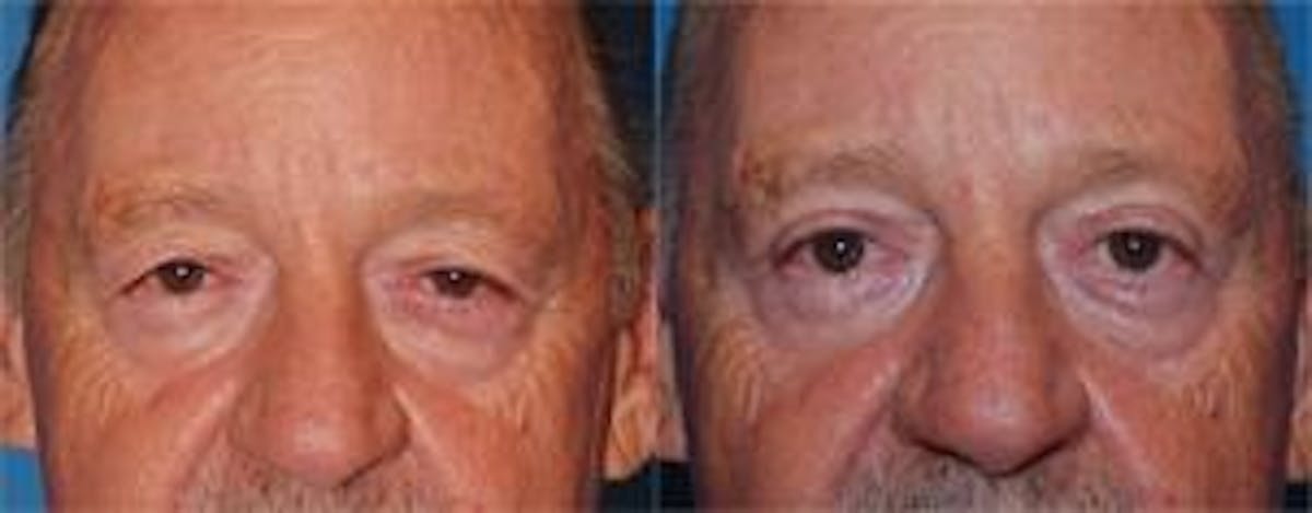Male Eyelid Surgery Before & After Gallery - Patient 122406346 - Image 1