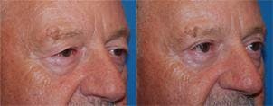 Male Eyelid Surgery Gallery - Patient 122406346 - Image 2