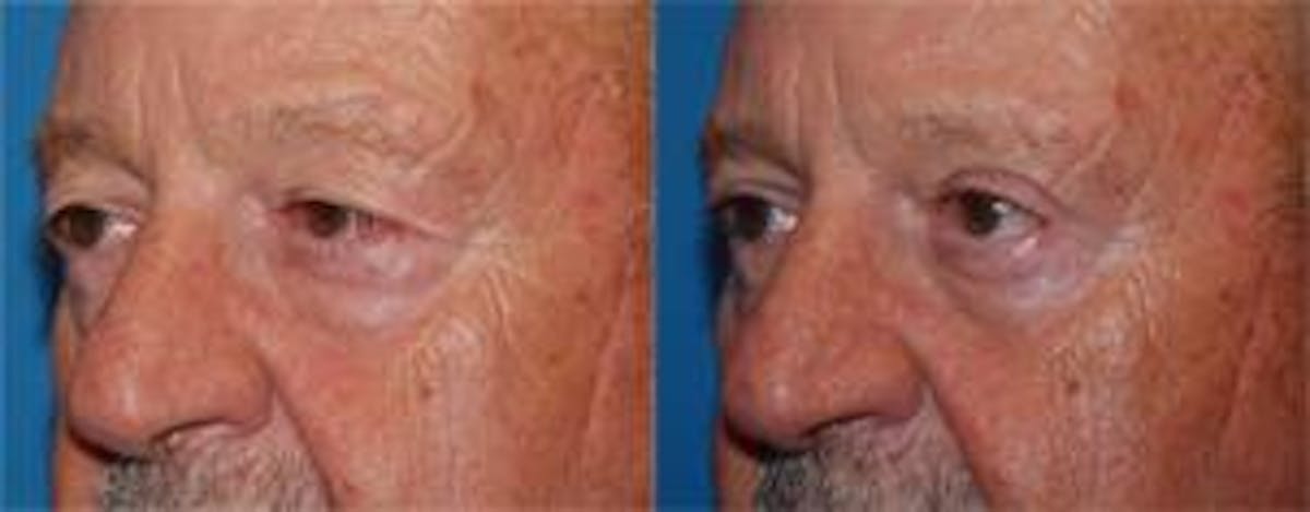 Male Eyelid Surgery Before & After Gallery - Patient 122406346 - Image 3