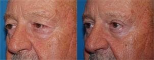 Male Eyelid Surgery Before & After Gallery - Patient 122406346 - Image 3
