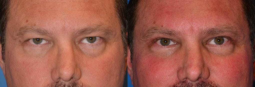 Male Eyelid Surgery Before & After Gallery - Patient 122406347 - Image 1