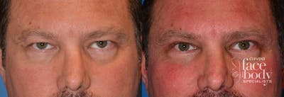Eyelid Surgery Before & After Gallery - Patient 314219 - Image 1