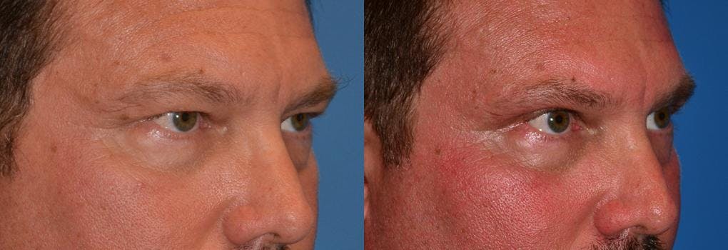 Male Eyelid Surgery Before & After Gallery - Patient 122406347 - Image 2