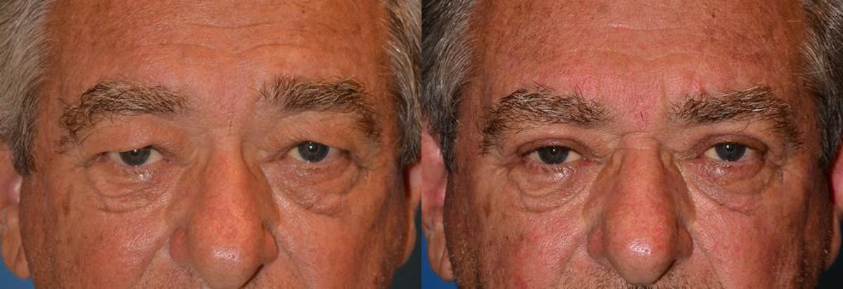 Male Eyelid Surgery Before & After Gallery - Patient 122406349 - Image 1