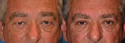 Male Eyelid Surgery Before & After Gallery - Patient 122406349 - Image 1