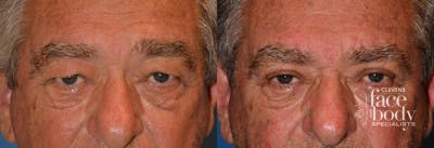 Eyelid Surgery Before & After Gallery - Patient 798937 - Image 1