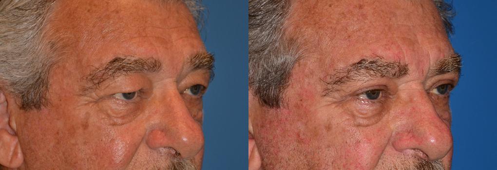 Eyelid Surgery Before & After Gallery - Patient 798937 - Image 2