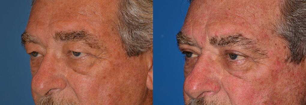Eyelid Surgery Before & After Gallery - Patient 798937 - Image 3