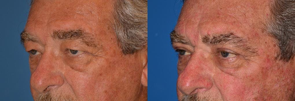 Male Eyelid Surgery Gallery - Patient 122406349 - Image 3