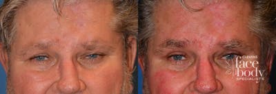 Eyelid Surgery Before & After Gallery - Patient 373423 - Image 1
