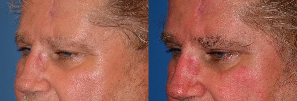 Male Eyelid Surgery Before & After Gallery - Patient 122406351 - Image 3