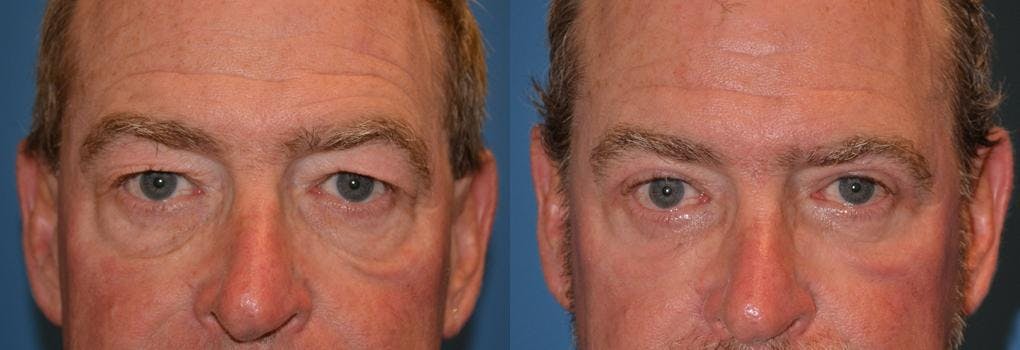 Male Eyelid Surgery Before & After Gallery - Patient 122406354 - Image 1