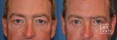 Eyelid Surgery Before & After Gallery - Patient 297352 - Image 1