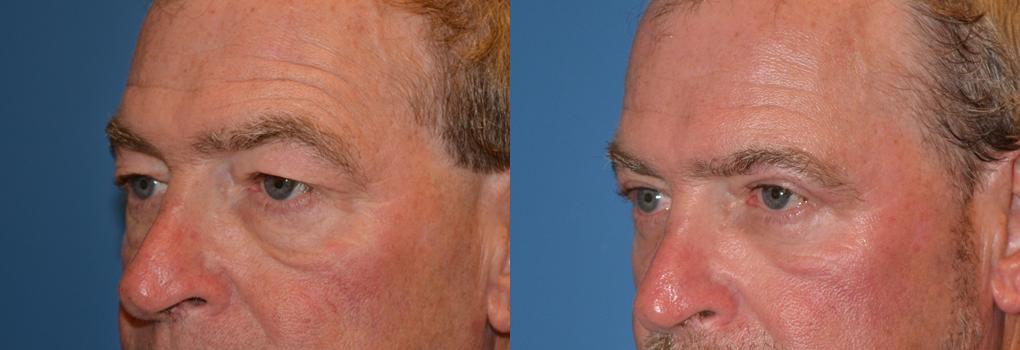 Eyelid Surgery Before & After Gallery - Patient 297352 - Image 3
