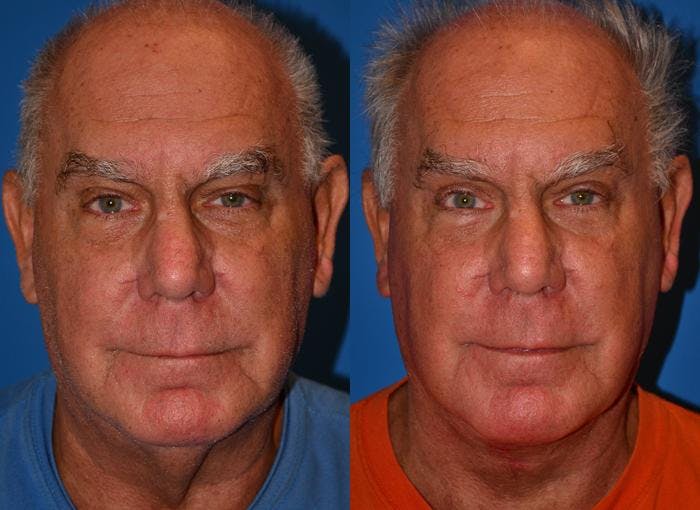Male Eyelid Surgery Before & After Gallery - Patient 122406355 - Image 1