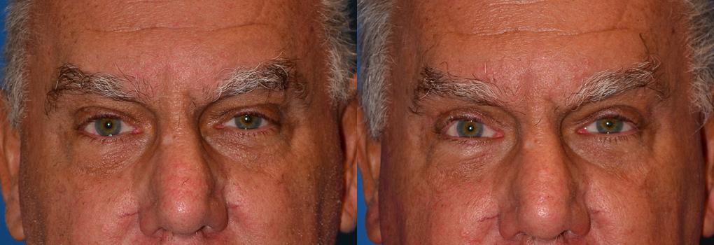 Eyelid Surgery Before & After Gallery - Patient 300131 - Image 1