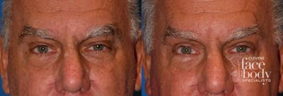 Eyelid Surgery Before & After Gallery - Patient 300131 - Image 1