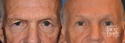 Eyelid Surgery Before & After Gallery - Patient 211509 - Image 1