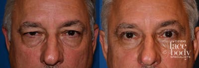 Eyelid Surgery Before & After Gallery - Patient 141001 - Image 1