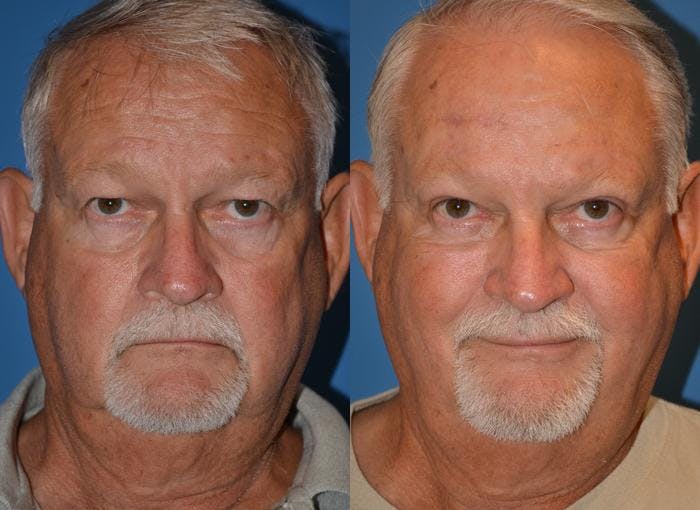 Male Eyelid Surgery Before & After Gallery - Patient 122406359 - Image 1