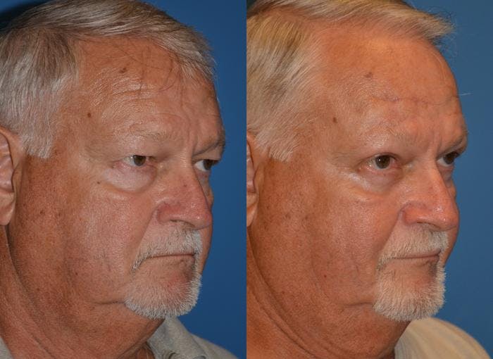 Male Eyelid Surgery Before & After Gallery - Patient 122406359 - Image 2