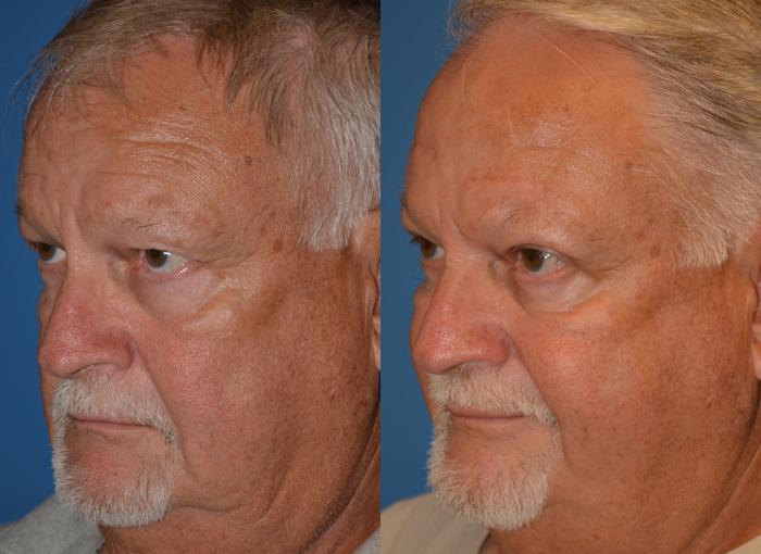 Male Eyelid Surgery Before & After Gallery - Patient 122406359 - Image 3