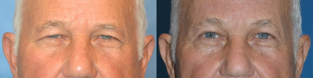 Male Eyelid Surgery Before & After Gallery - Patient 122406360 - Image 1