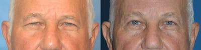 Male Eyelid Surgery Before & After Gallery - Patient 122406360 - Image 1