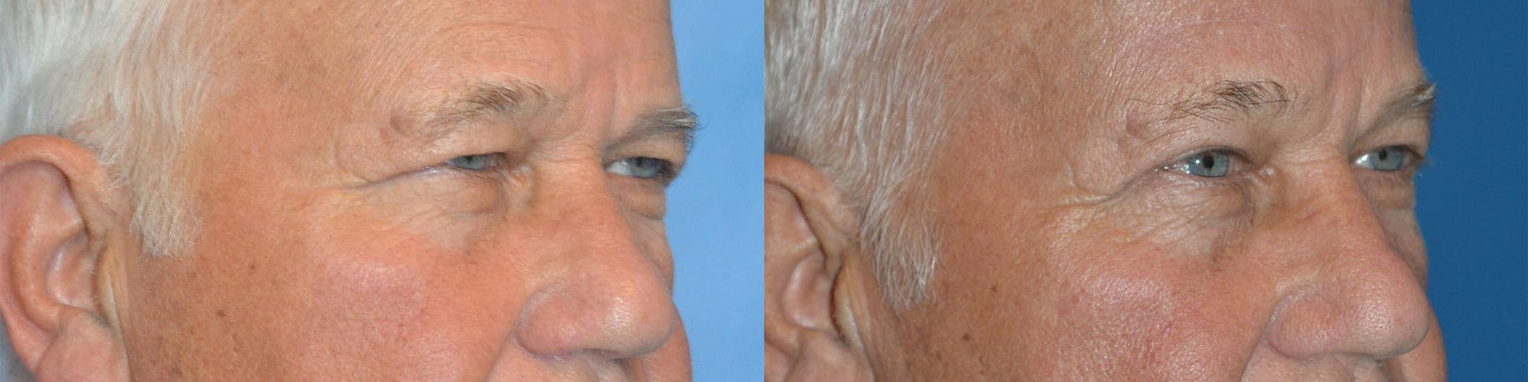 Male Eyelid Surgery Before & After Gallery - Patient 122406360 - Image 3