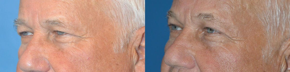 Male Eyelid Surgery Before & After Gallery - Patient 122406360 - Image 5